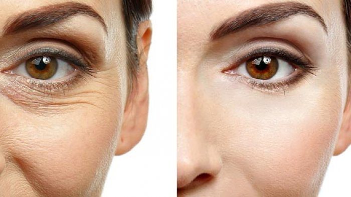 5 Makanan yang Berdampak Buruk bagi Kulit: Akibatkan Keriput hingga Pembengkakan Kantung Mata