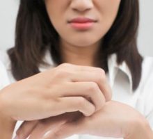 Cara Menghilangkan Bekas Gigitan Nyamuk dengan Mudah